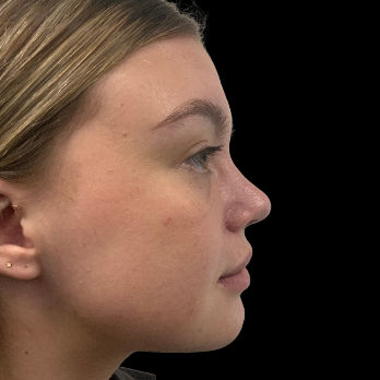 Ultrasonic-rhinoplasty-after